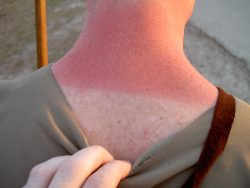 Why does sunburned skin peel?